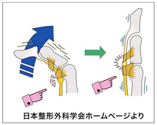 バネ指のメカニズム